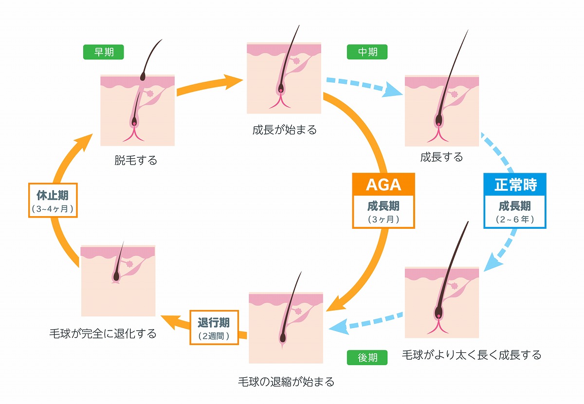 ヘアサイクルの乱れ